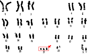 300px21_trisomy__down_syndrome
